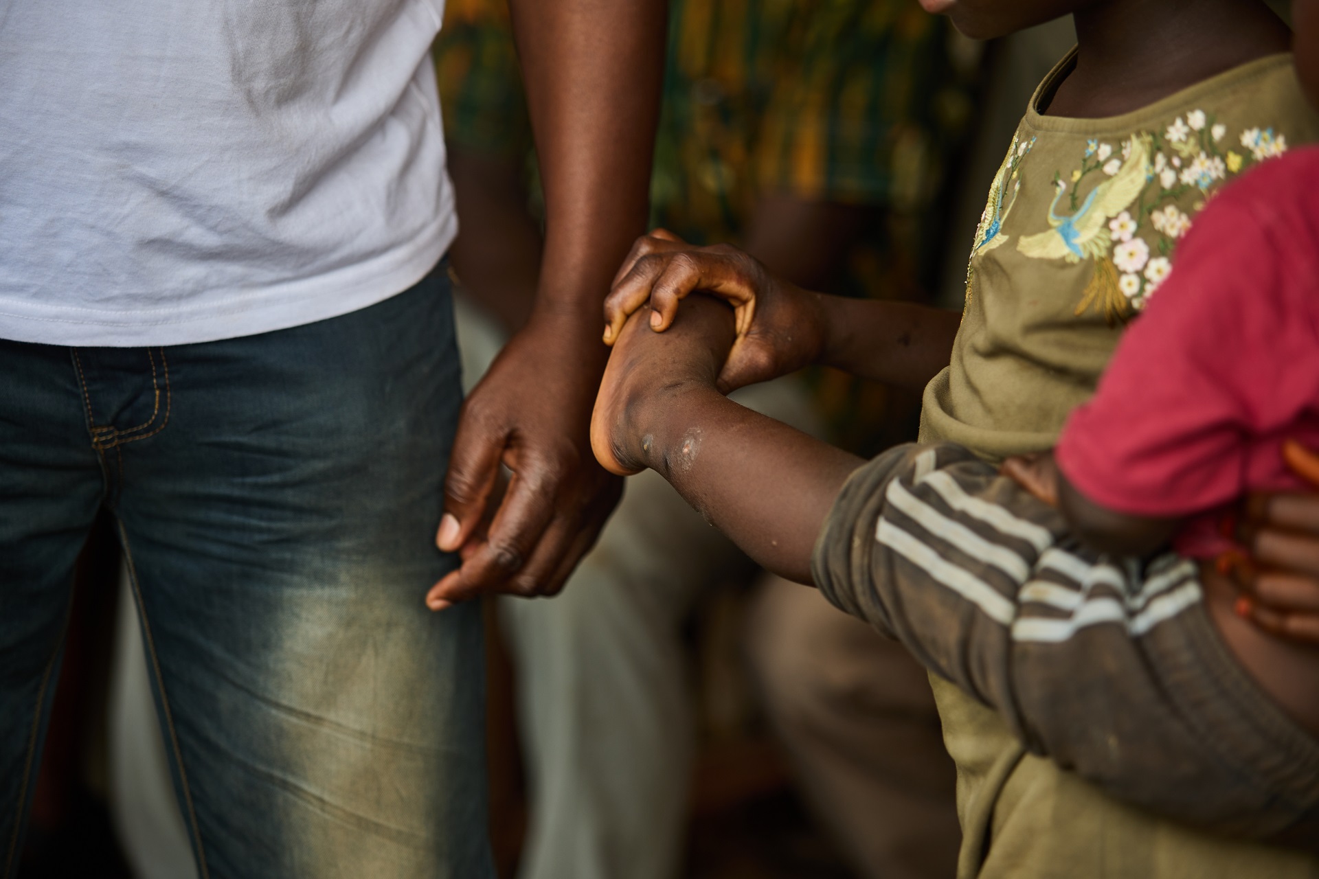 A mother with her son at a district health center getting diagnosed for a skin-related NTDs in sub-Saharan Africa